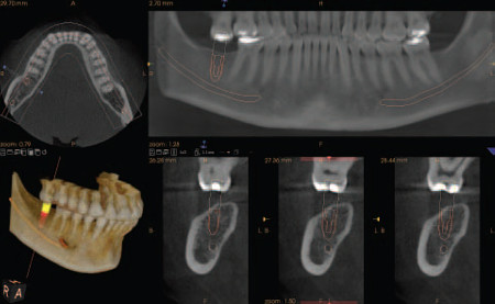 3D - Röntgen / Digitale Volumentomographie (DVT)